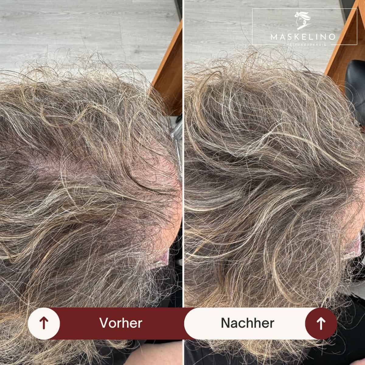 Haarverdichtung bei feinem Haar Vorher/Nachher für volles und dickes Haar